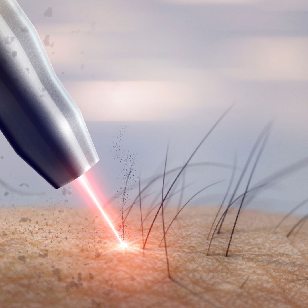 Lumix™ Permanent Hair Removal System