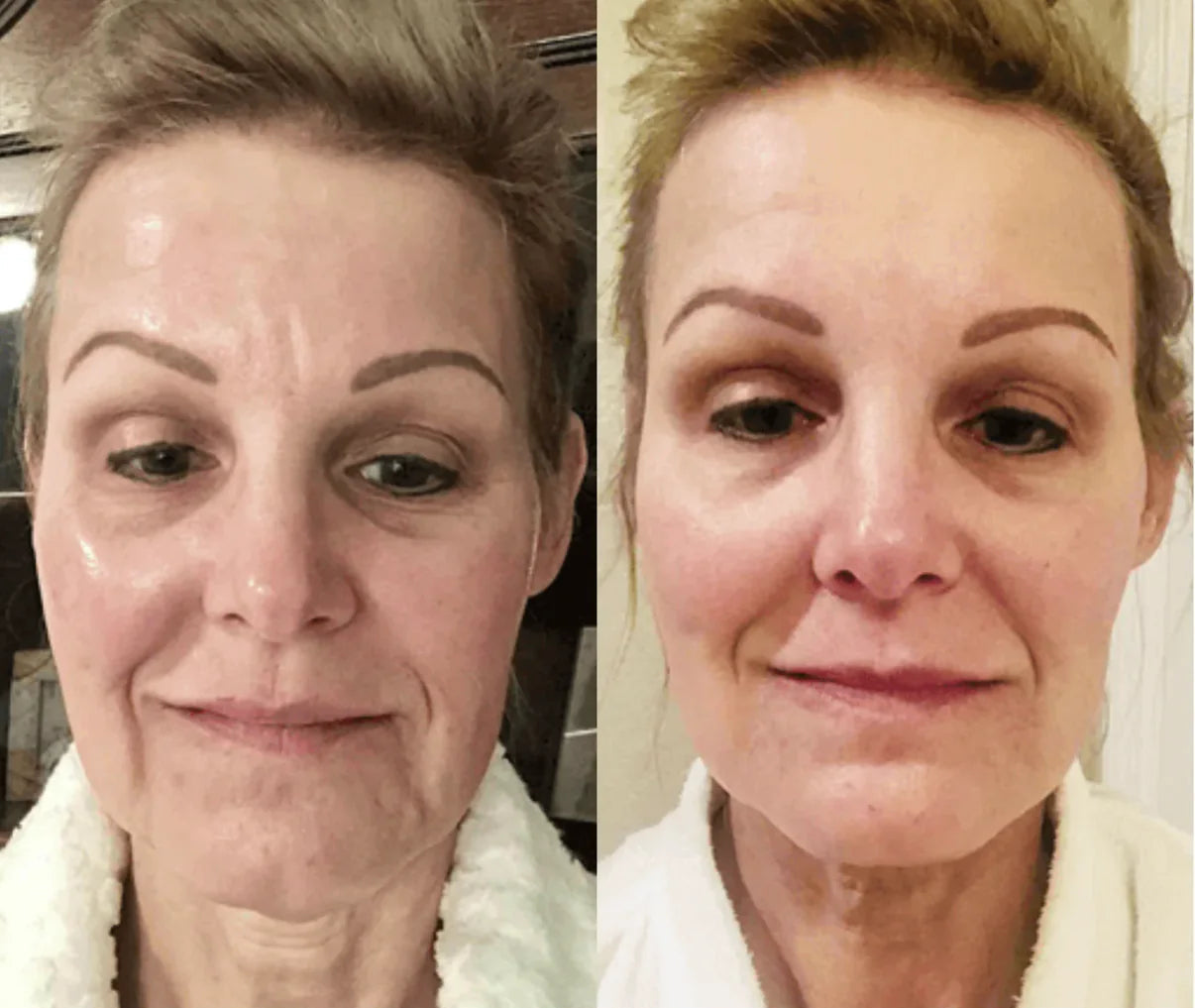 DERMALifter (Copy) before reza