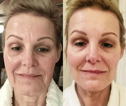 DERMALifter (Copy) before reza