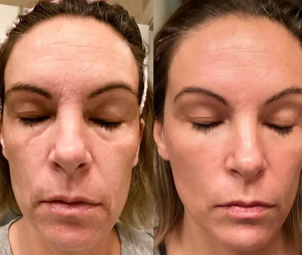 DERMALifter (Copy) before reza