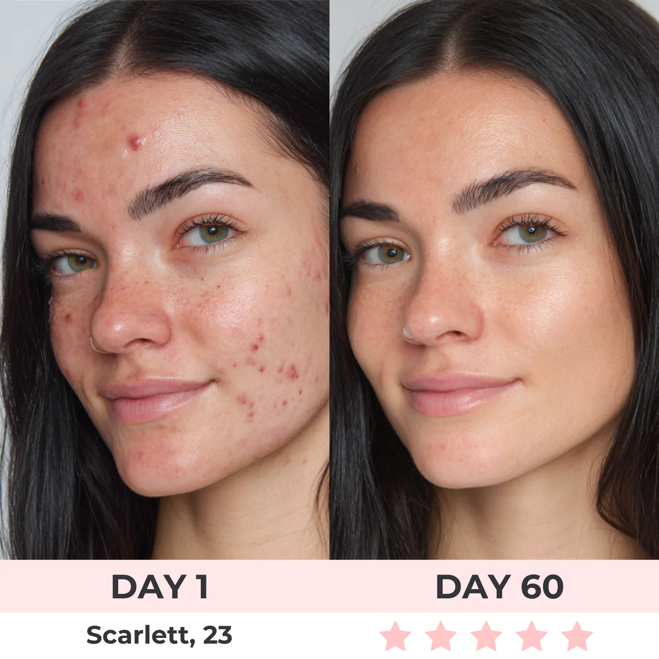 DERMALifter (Copy) before reza