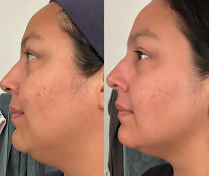 DERMALifter (Copy) before reza