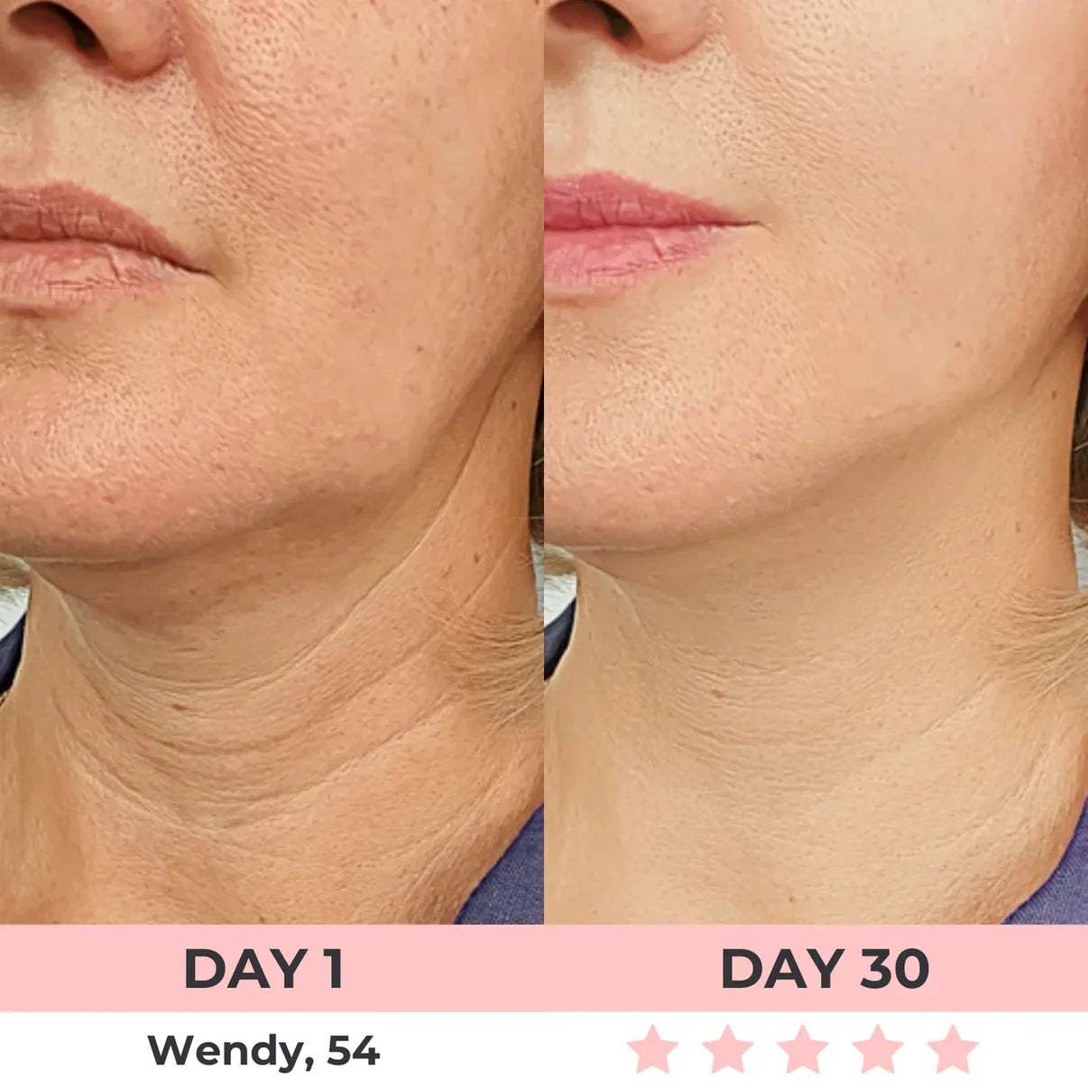 DERMALifter (Copy) before reza